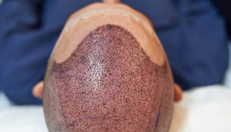 hair transplant in Arizona