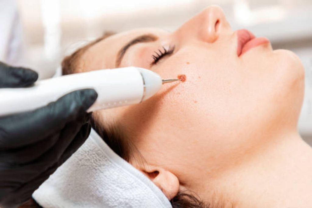 How to Find a Mole Removal Near Me in New York