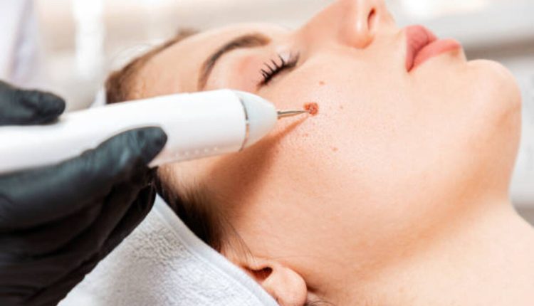 How to Find a Mole Removal Near Me in New York